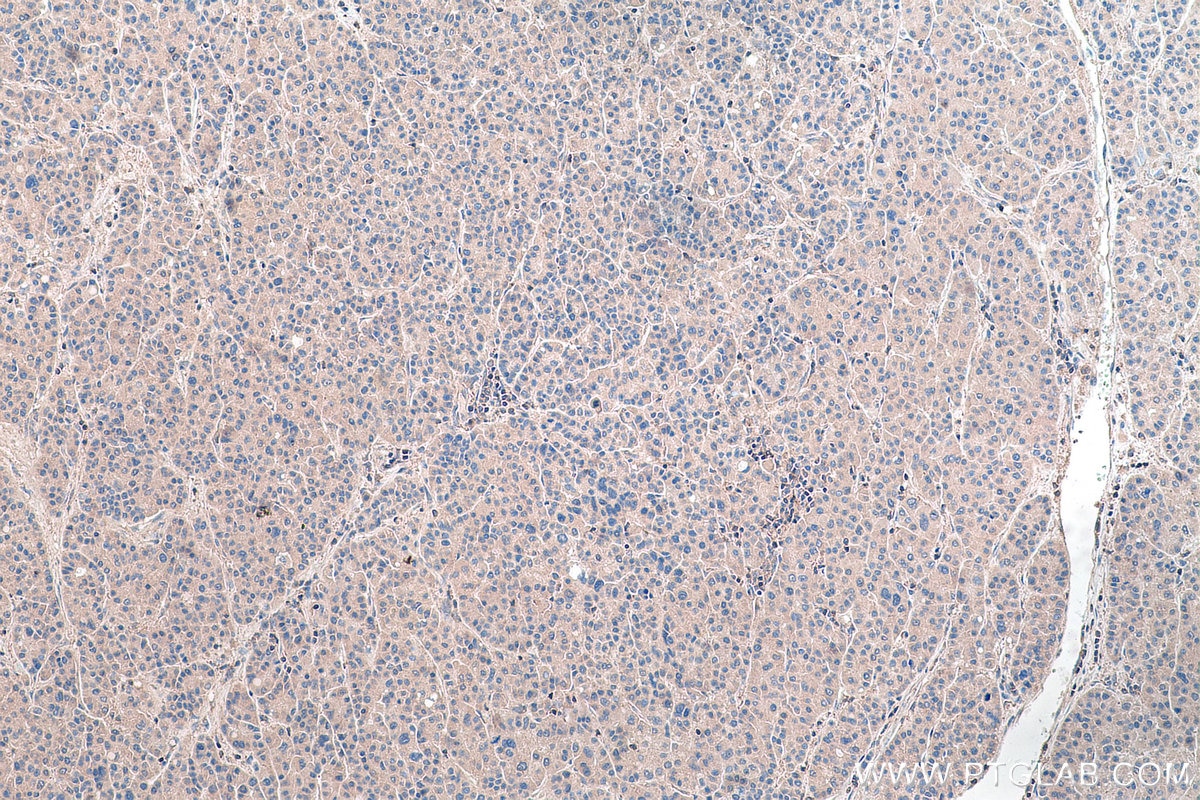 IHC staining of human liver cancer using 24049-1-AP