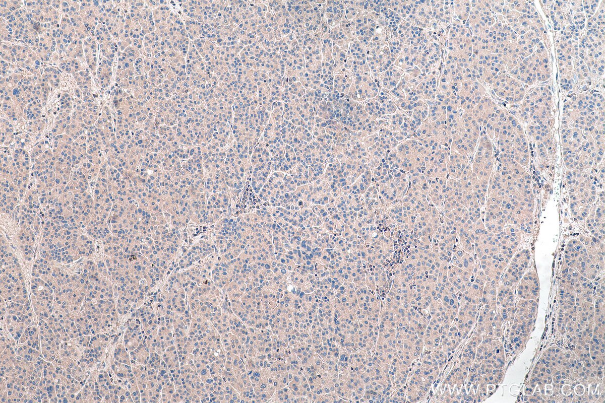 Immunohistochemistry (IHC) staining of human liver cancer tissue using KRT23 Polyclonal antibody (24049-1-AP)