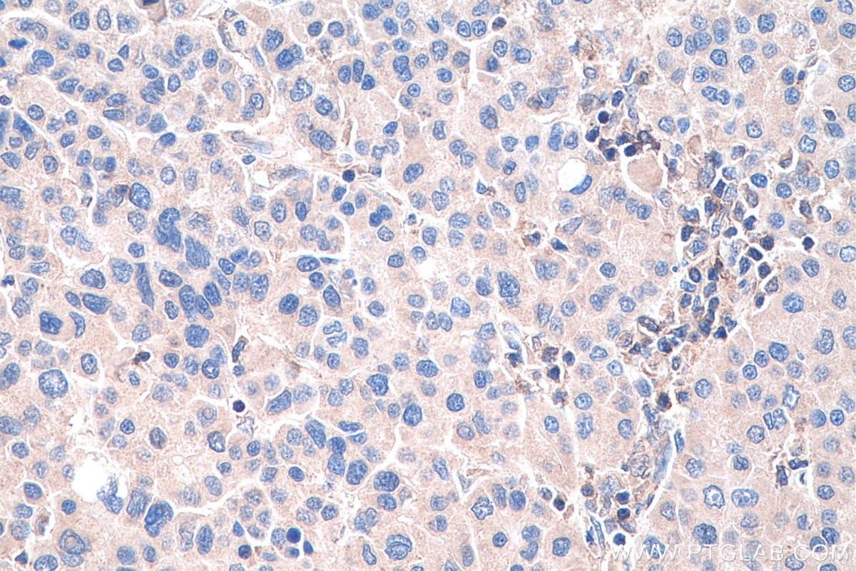 Immunohistochemistry (IHC) staining of human liver cancer tissue using KRT23 Polyclonal antibody (24049-1-AP)
