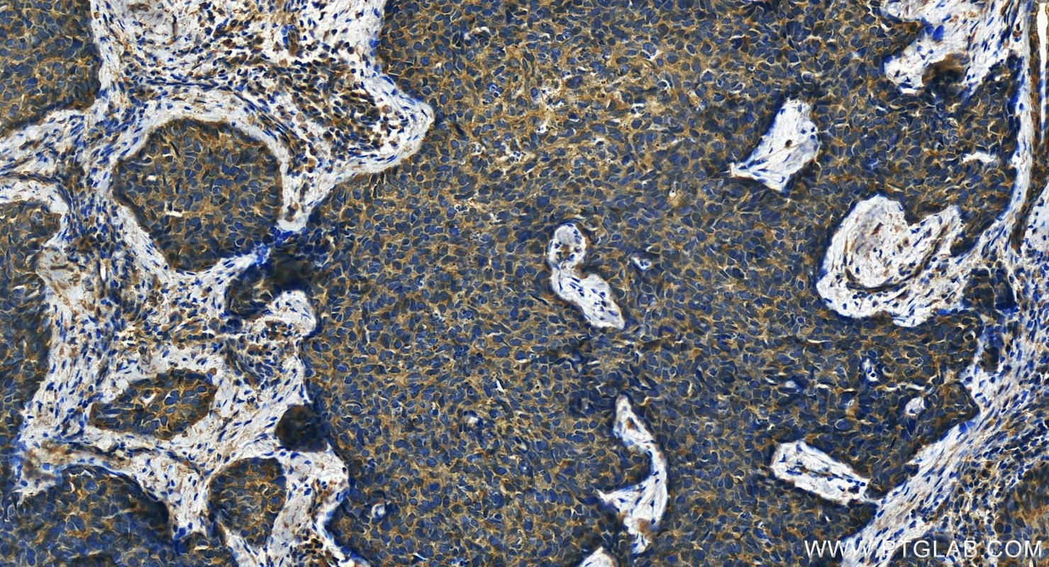 Immunohistochemistry (IHC) staining of human bowen disease tissue using Cytokeratin 23 Polyclonal antibody (24049-1-AP)