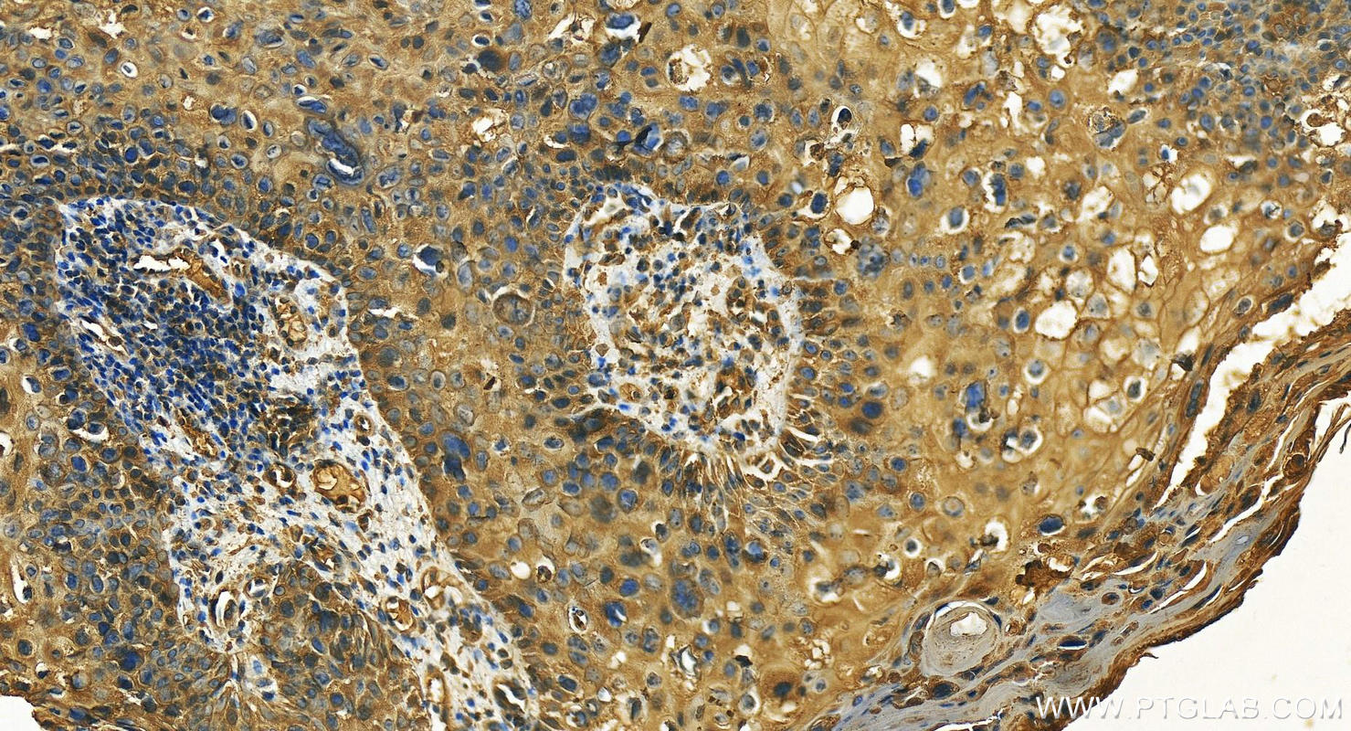 Immunohistochemistry (IHC) staining of human bowen disease tissue using Cytokeratin 23 Polyclonal antibody (24049-1-AP)