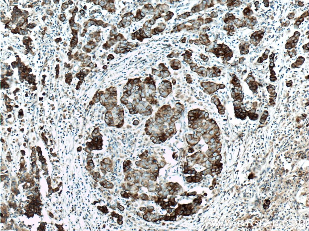 Immunohistochemistry (IHC) staining of human prostate cancer tissue using KRT33B Polyclonal antibody (11048-1-AP)