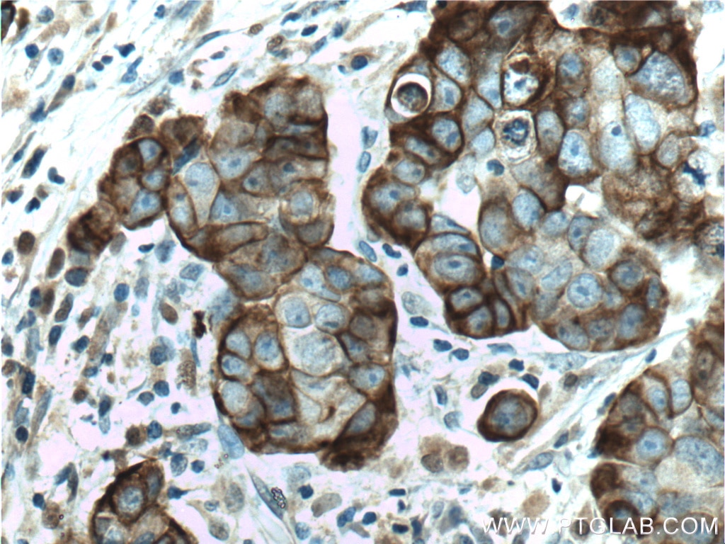 Immunohistochemistry (IHC) staining of human prostate cancer tissue using KRT33B Polyclonal antibody (11048-1-AP)