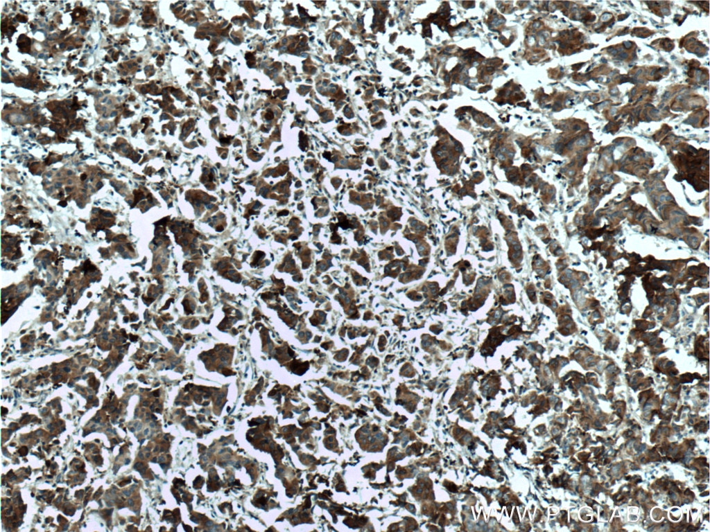 IHC staining of human prostate cancer using 11048-1-AP