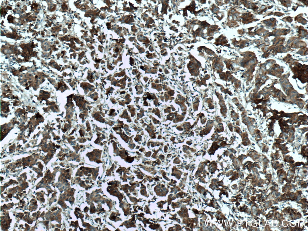 Immunohistochemistry (IHC) staining of human prostate cancer tissue using KRT33B Polyclonal antibody (11048-1-AP)