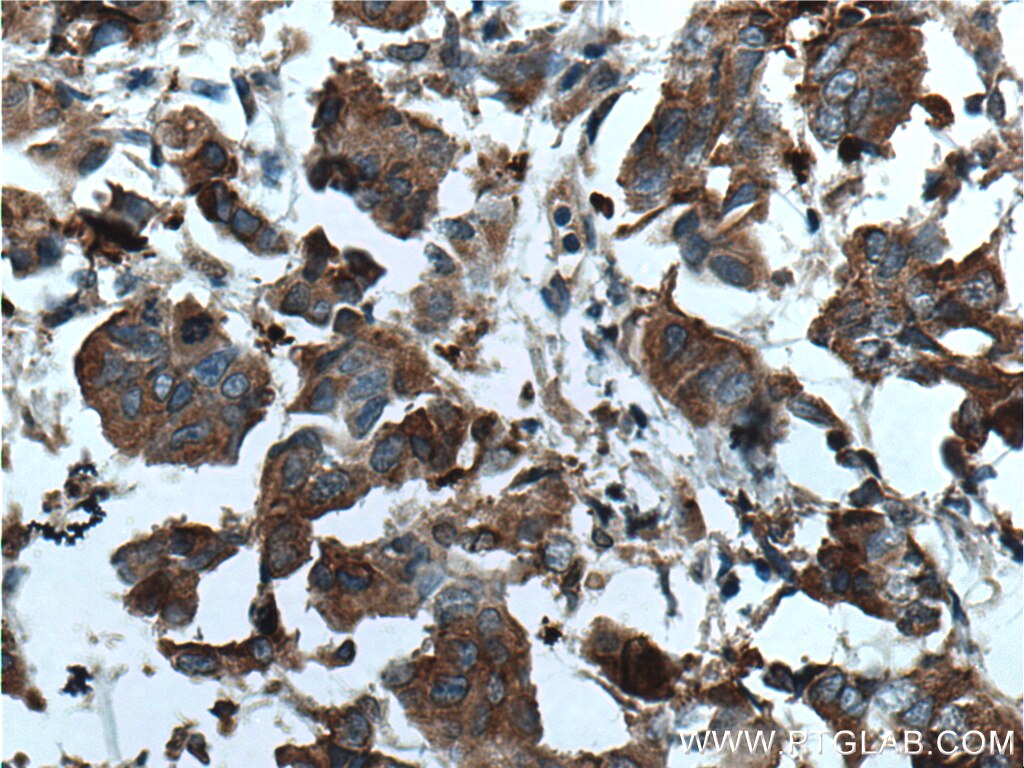 Immunohistochemistry (IHC) staining of human prostate cancer tissue using KRT33B Polyclonal antibody (11048-1-AP)