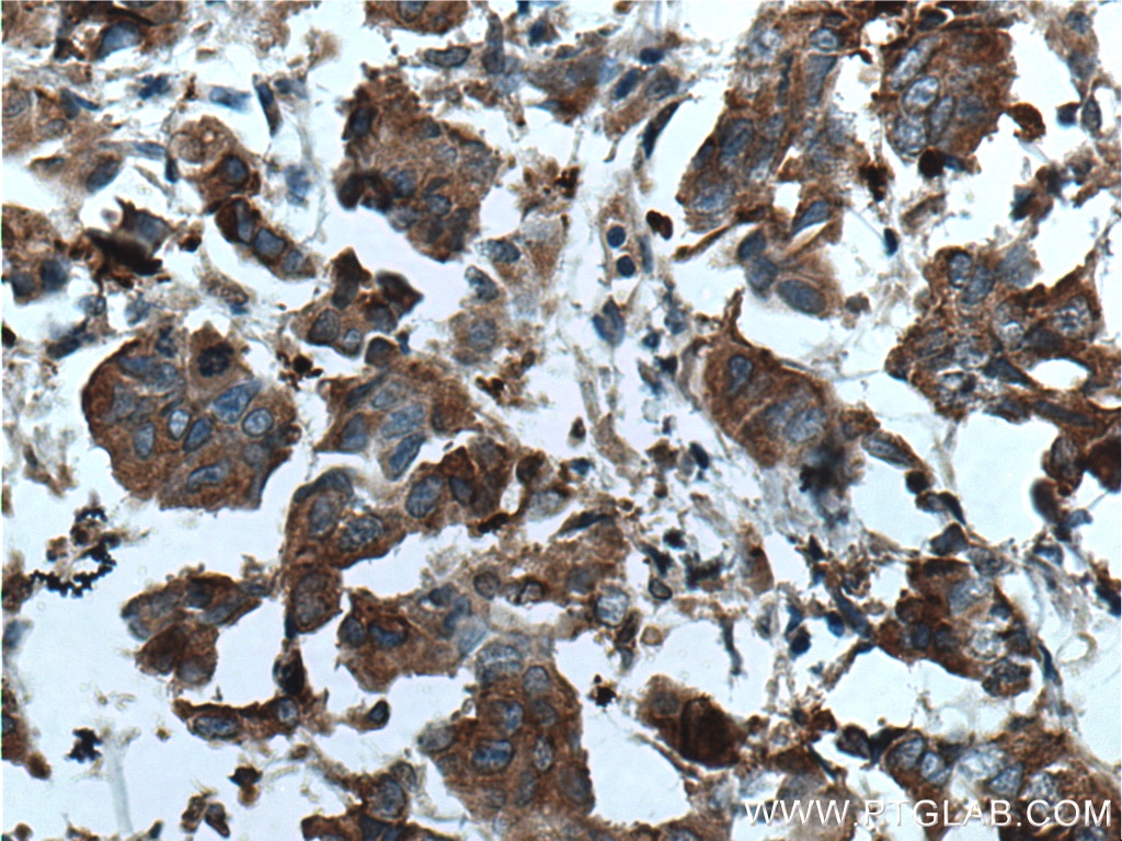 Immunohistochemistry (IHC) staining of human prostate cancer tissue using KRT33B Polyclonal antibody (11048-1-AP)