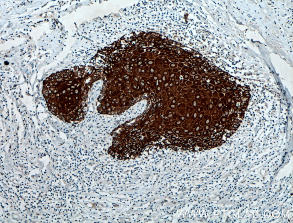 Immunohistochemistry (IHC) staining of human skin cancer tissue using KRT33B Polyclonal antibody (11048-1-AP)