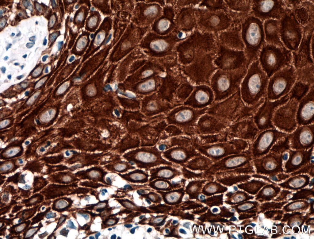 Immunohistochemistry (IHC) staining of human skin cancer tissue using KRT33B Polyclonal antibody (11048-1-AP)