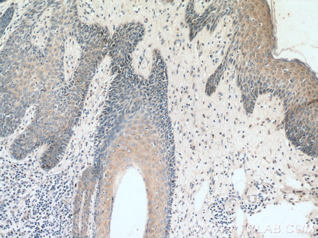 IHC staining of human skin cancer using 14309-1-AP