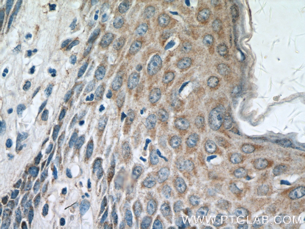 Immunohistochemistry (IHC) staining of human skin cancer tissue using KRT36 Polyclonal antibody (14309-1-AP)