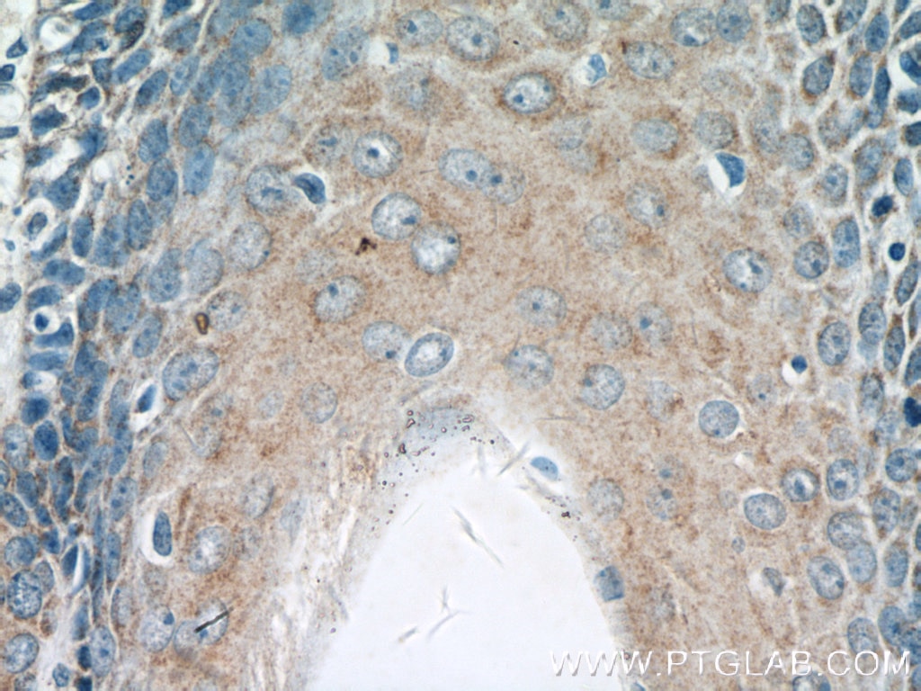 Immunohistochemistry (IHC) staining of human skin cancer tissue using KRT36 Polyclonal antibody (14309-1-AP)