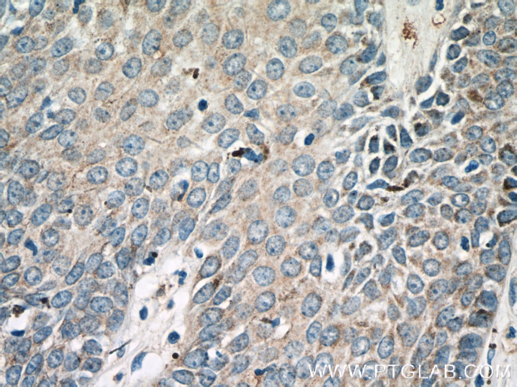 IHC staining of human skin cancer using 14309-1-AP