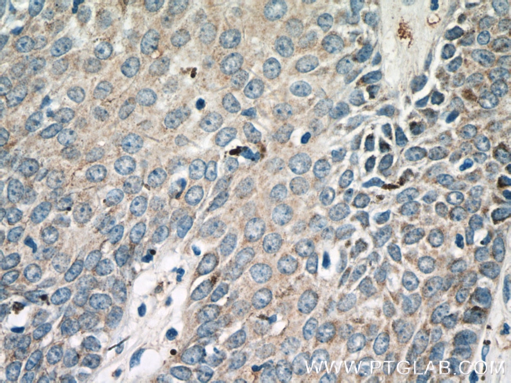 Immunohistochemistry (IHC) staining of human skin cancer tissue using KRT36 Polyclonal antibody (14309-1-AP)