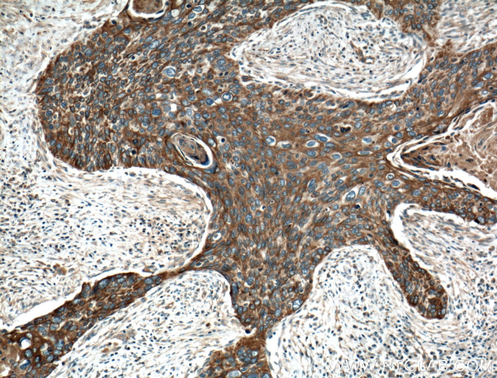 Immunohistochemistry (IHC) staining of human cervical cancer tissue using Cytokeratin 4 Polyclonal antibody (16572-1-AP)