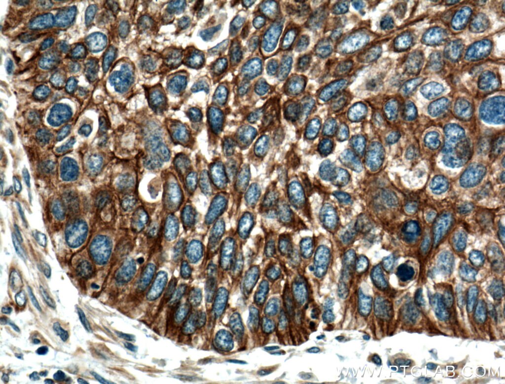 Immunohistochemistry (IHC) staining of human cervical cancer tissue using Cytokeratin 4 Polyclonal antibody (16572-1-AP)