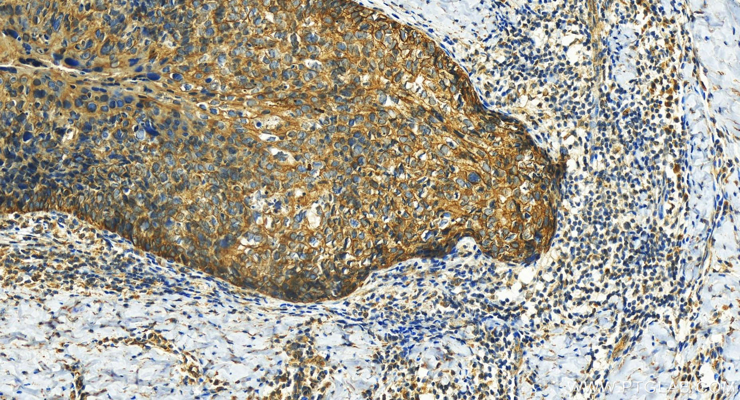 Immunohistochemistry (IHC) staining of human bowen disease using Cytokeratin 4 Polyclonal antibody (16572-1-AP)