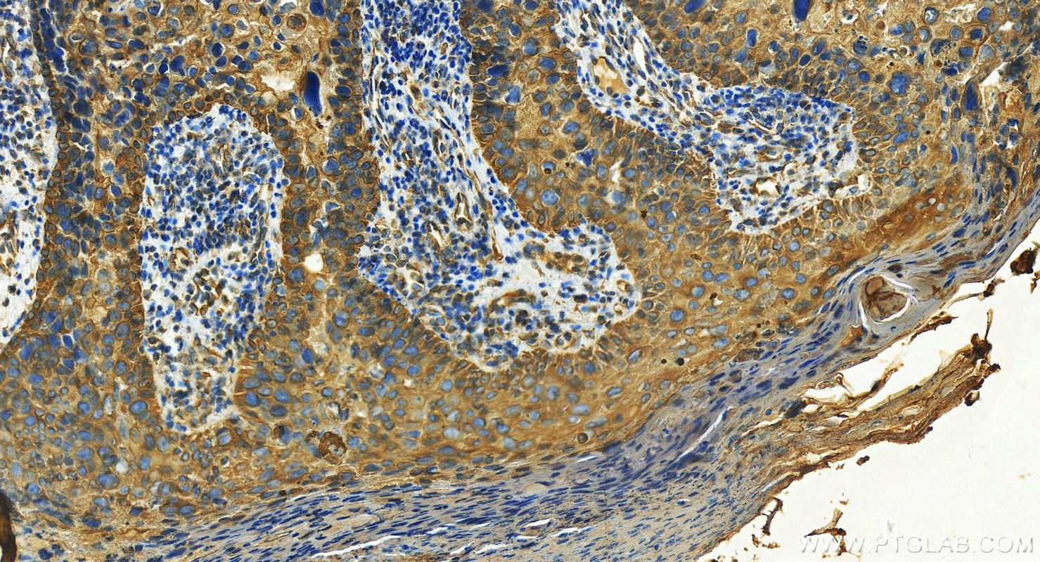 Immunohistochemistry (IHC) staining of human bowen disease using Cytokeratin 4 Polyclonal antibody (16572-1-AP)