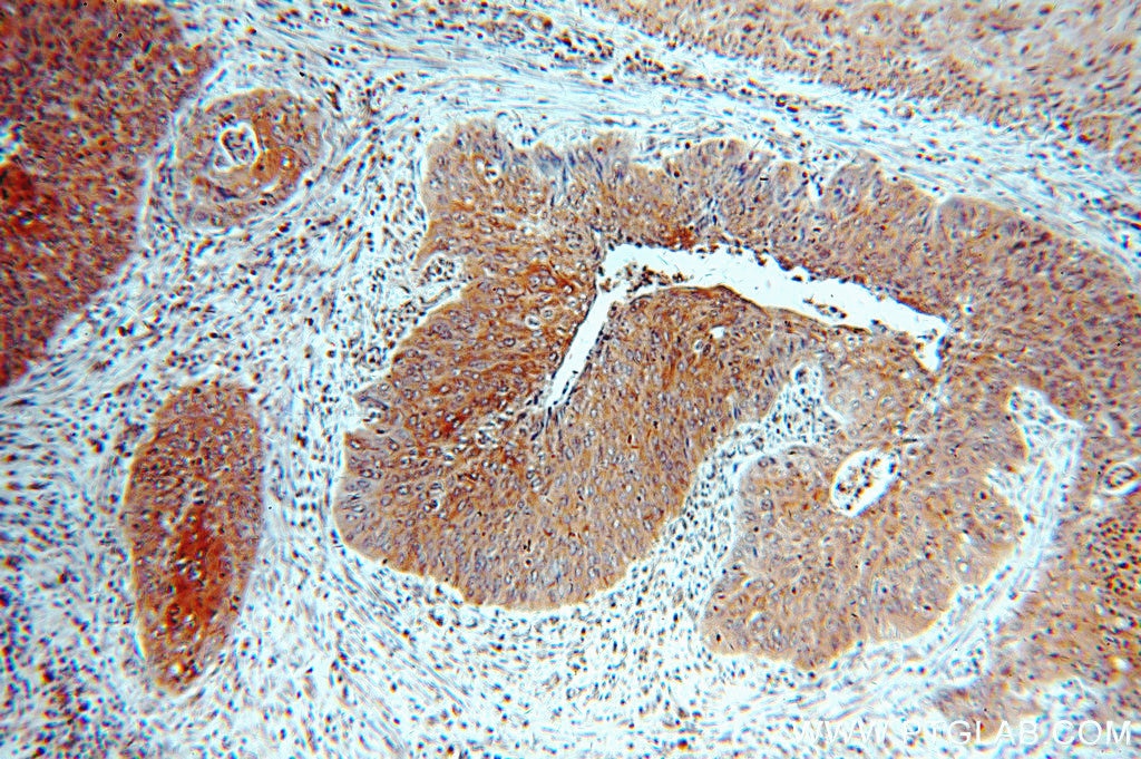 Immunohistochemistry (IHC) staining of human cervical cancer tissue using Cytokeratin 5-specific Polyclonal antibody (16852-1-AP)