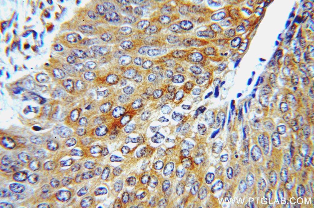 Immunohistochemistry (IHC) staining of human cervical cancer tissue using Cytokeratin 5-specific Polyclonal antibody (16852-1-AP)