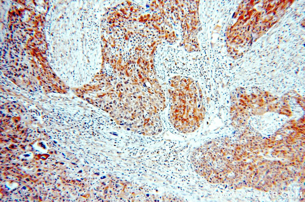 Immunohistochemistry (IHC) staining of human lung cancer tissue using Cytokeratin 5-specific Polyclonal antibody (16852-1-AP)