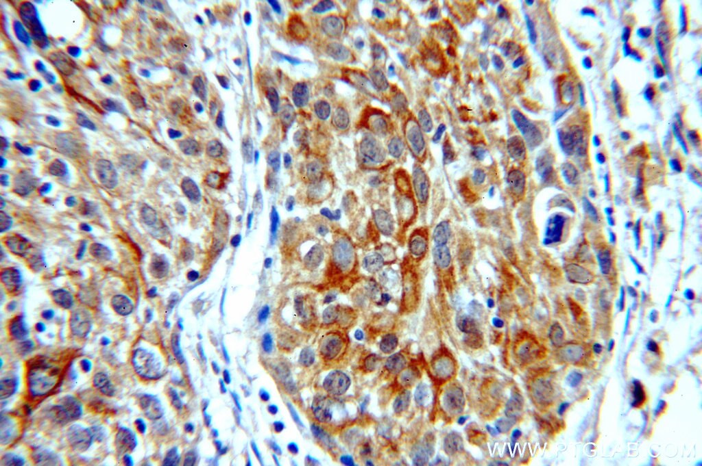 Immunohistochemistry (IHC) staining of human lung cancer tissue using Cytokeratin 5-specific Polyclonal antibody (16852-1-AP)