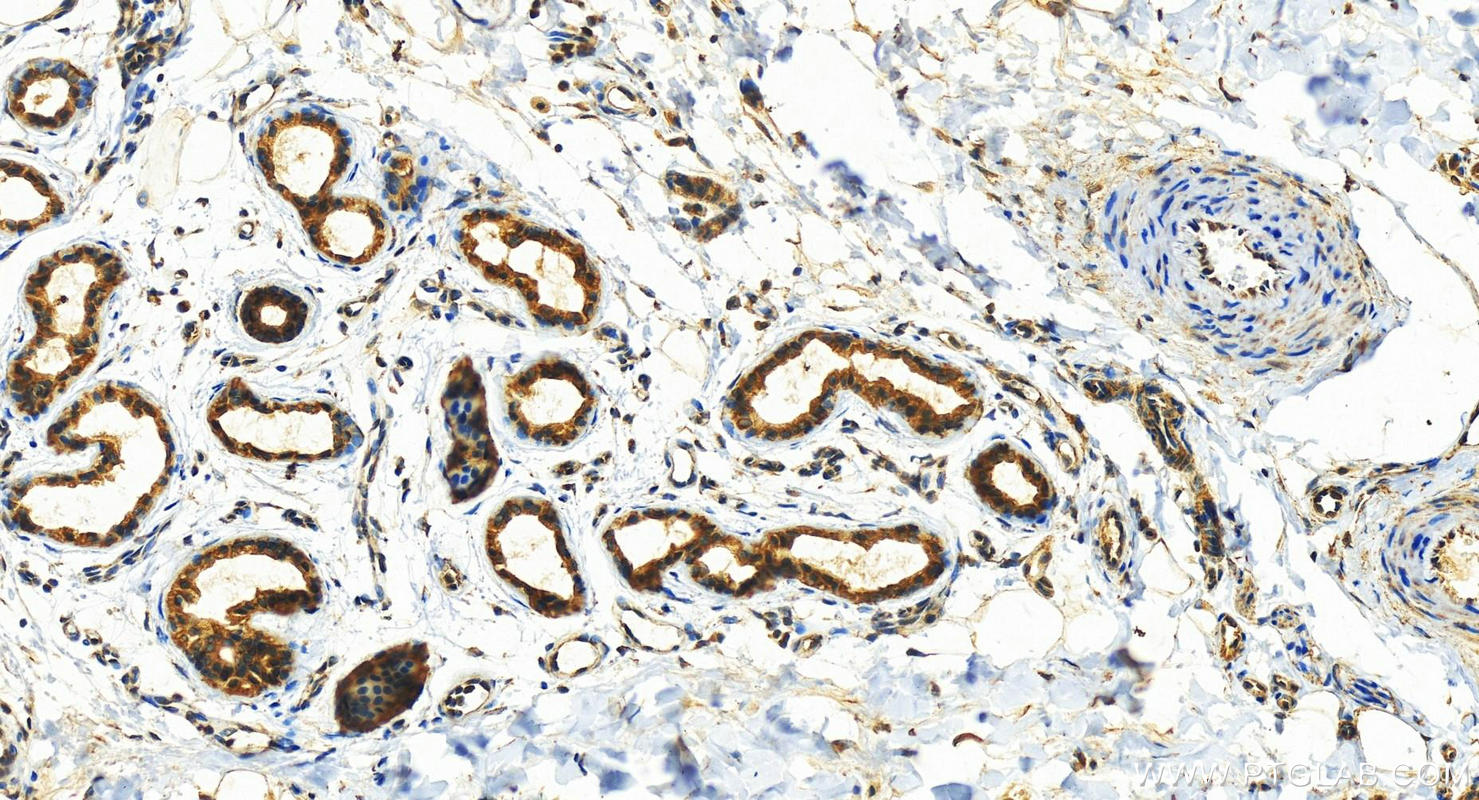 Immunohistochemistry (IHC) staining of human bowen disease tissue using Cytokeratin 6A-specific Polyclonal antibody (16853-1-AP)