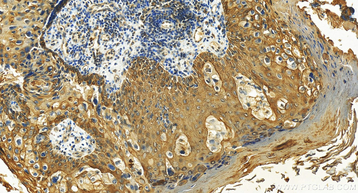 Immunohistochemistry (IHC) staining of human bowen disease tissue using Cytokeratin 6A-specific Polyclonal antibody (16853-1-AP)