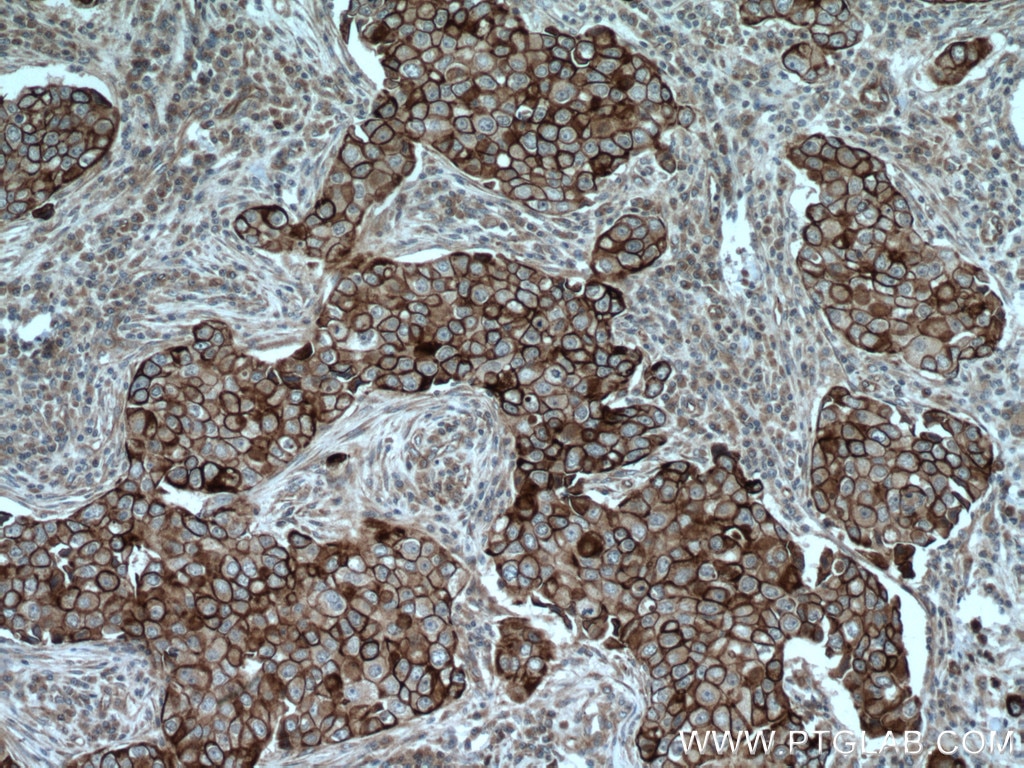 Immunohistochemistry (IHC) staining of human breast cancer tissue using Cytokeratin 6A Polyclonal antibody (10590-1-AP)