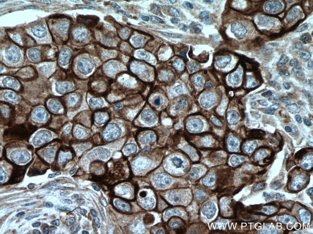 Immunohistochemistry (IHC) staining of human breast cancer tissue using Cytokeratin 6A Polyclonal antibody (10590-1-AP)