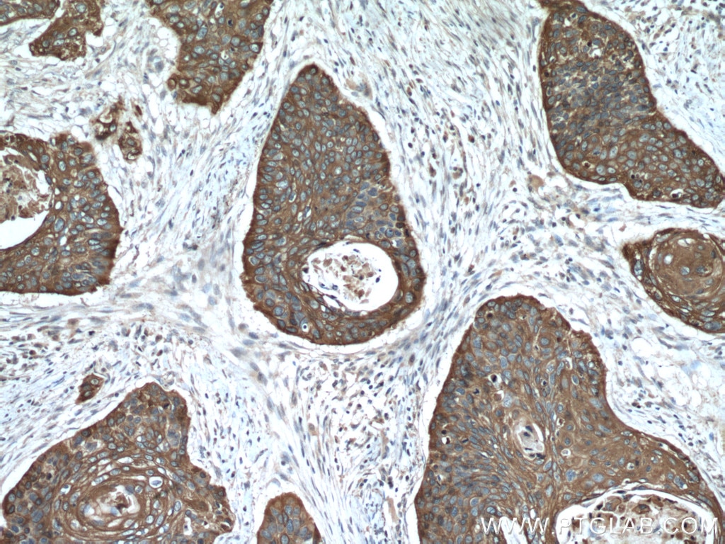 Immunohistochemistry (IHC) staining of human oesophagus cancer tissue using Cytokeratin 6A Polyclonal antibody (10590-1-AP)