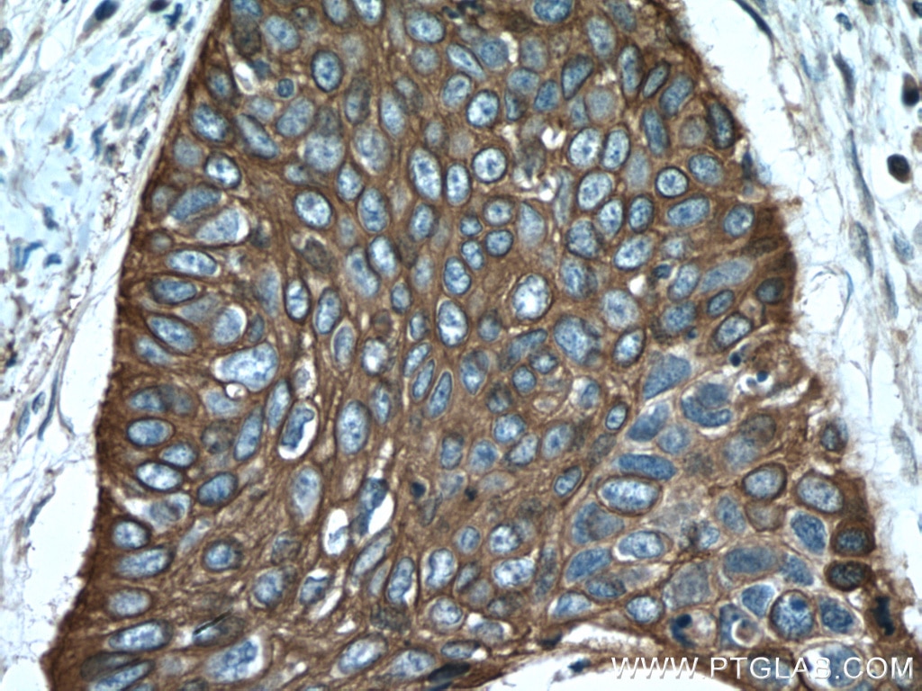 Immunohistochemistry (IHC) staining of human oesophagus cancer tissue using Cytokeratin 6A Polyclonal antibody (10590-1-AP)