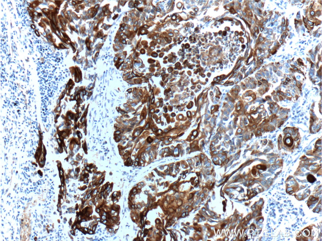 Immunohistochemistry (IHC) staining of human lung cancer tissue using Cytokeratin 6A Polyclonal antibody (10590-1-AP)