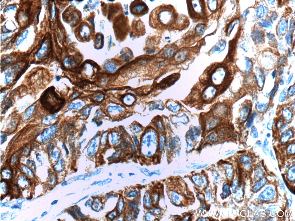 Immunohistochemistry (IHC) staining of human lung cancer tissue using Cytokeratin 6A Polyclonal antibody (10590-1-AP)