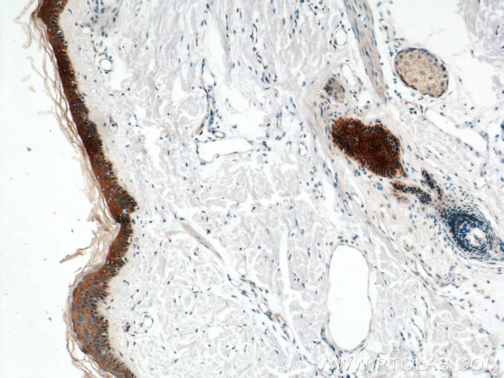 Immunohistochemistry (IHC) staining of human skin tissue using Cytokeratin 6A Polyclonal antibody (10590-1-AP)