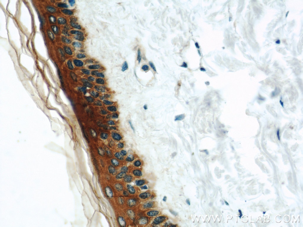 Immunohistochemistry (IHC) staining of human skin tissue using Cytokeratin 6A Polyclonal antibody (10590-1-AP)