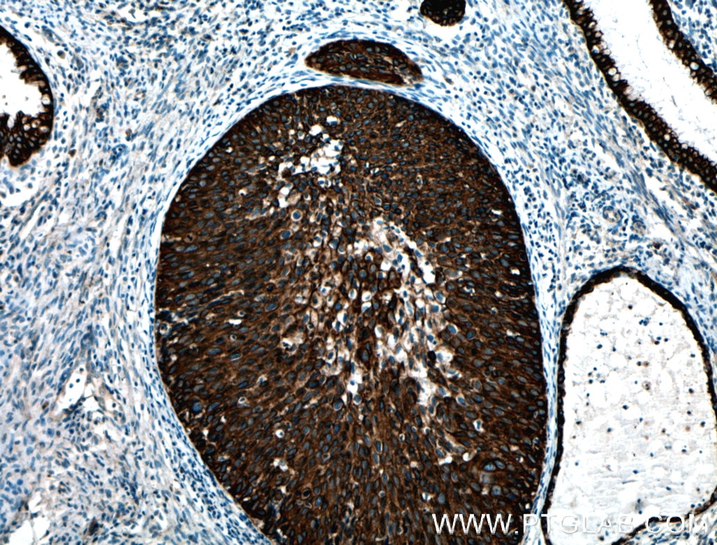 Immunohistochemistry (IHC) staining of human cervical cancer tissue using Cytokeratin 6B Polyclonal antibody (17391-1-AP)