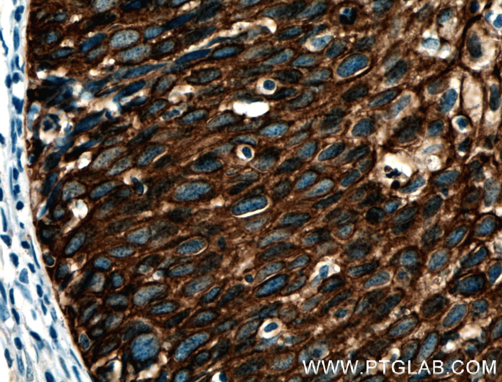 Immunohistochemistry (IHC) staining of human cervical cancer tissue using Cytokeratin 6B Polyclonal antibody (17391-1-AP)