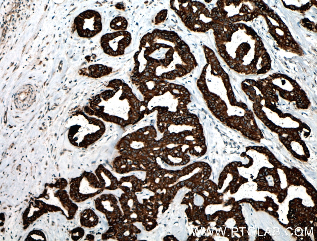 Immunohistochemistry (IHC) staining of human breast cancer tissue using Cytokeratin 6B Polyclonal antibody (17391-1-AP)