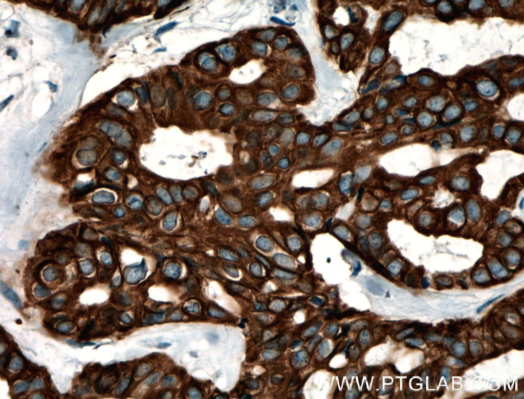 Immunohistochemistry (IHC) staining of human breast cancer tissue using Cytokeratin 6B Polyclonal antibody (17391-1-AP)