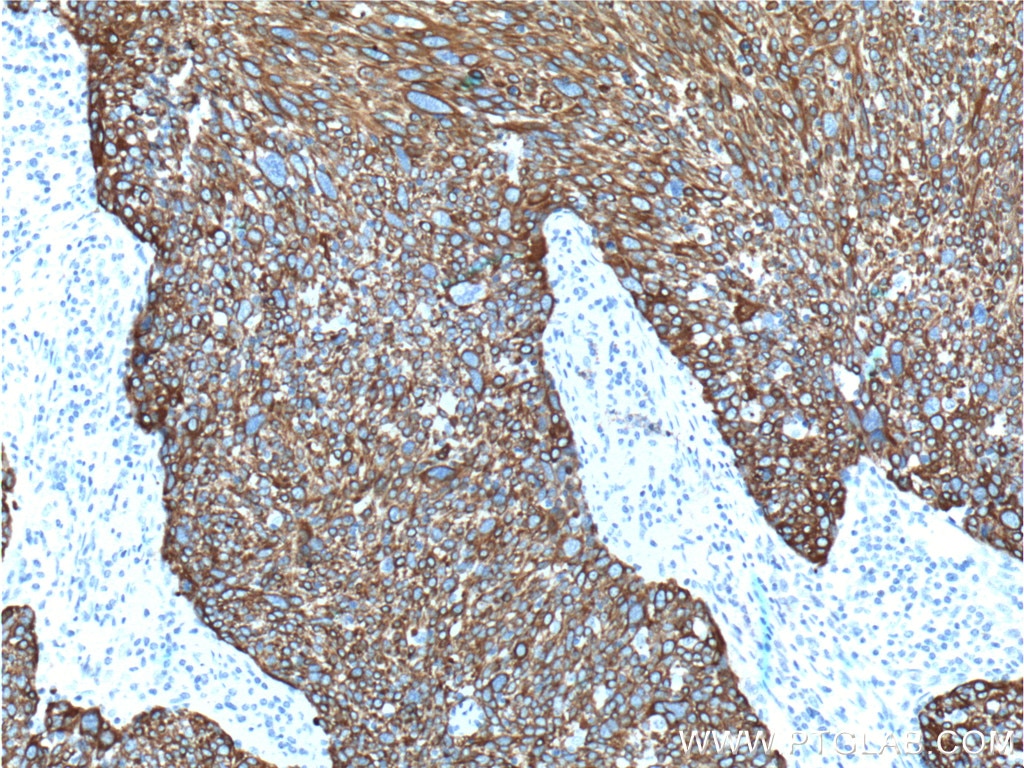 Immunohistochemistry (IHC) staining of human lung cancer tissue using Cytokeratin 6B Polyclonal antibody (17391-1-AP)