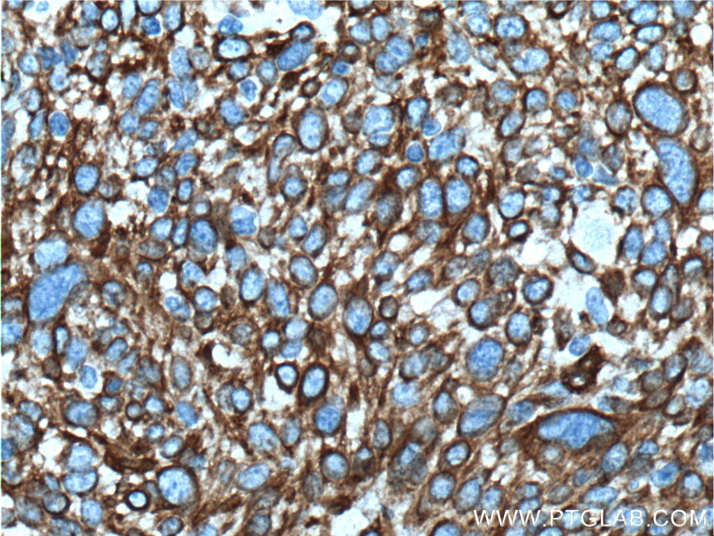 Immunohistochemistry (IHC) staining of human lung cancer tissue using Cytokeratin 6B Polyclonal antibody (17391-1-AP)