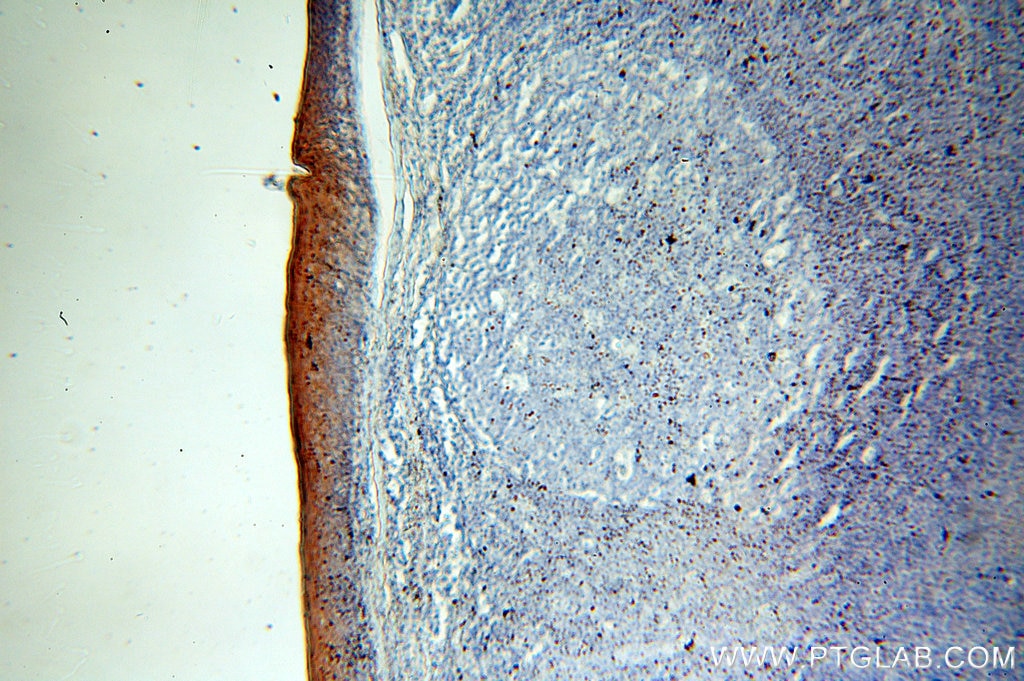 Immunohistochemistry (IHC) staining of human tonsil tissue using Cytokeratin 6B Polyclonal antibody (17391-1-AP)