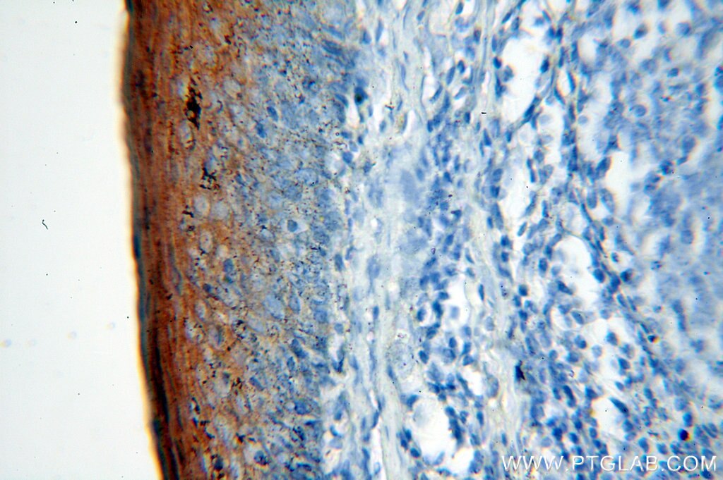 Immunohistochemistry (IHC) staining of human tonsil tissue using Cytokeratin 6B Polyclonal antibody (17391-1-AP)