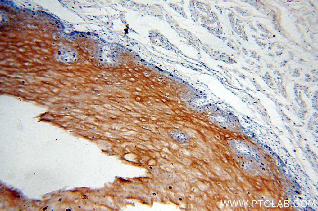 Immunohistochemistry (IHC) staining of human oesophagus tissue using Cytokeratin 6B Polyclonal antibody (17391-1-AP)