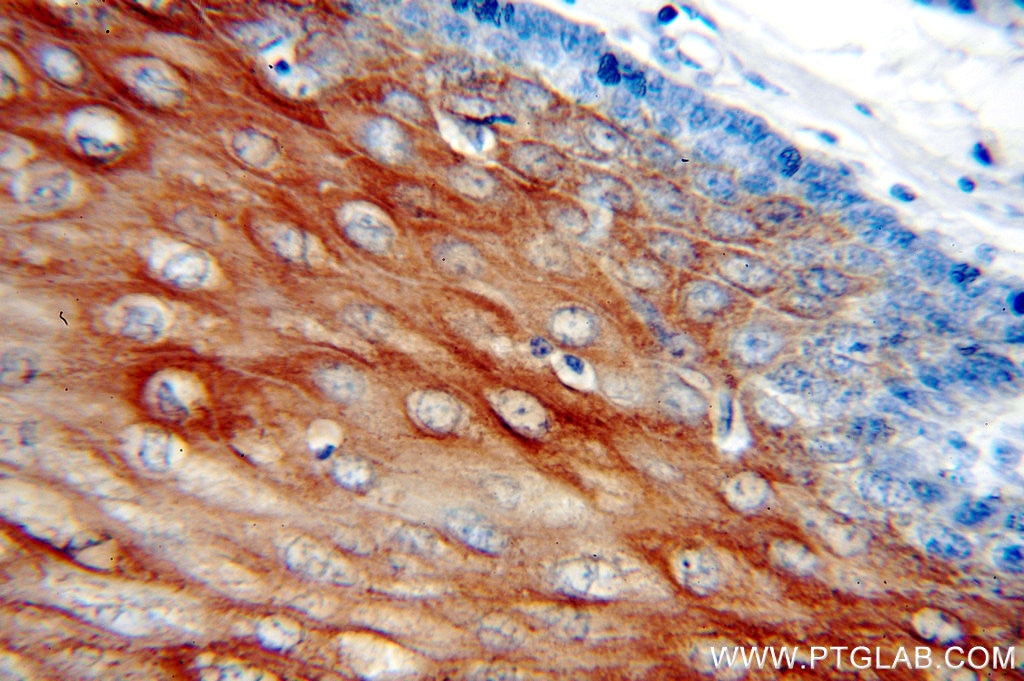 Immunohistochemistry (IHC) staining of human oesophagus tissue using Cytokeratin 6B Polyclonal antibody (17391-1-AP)