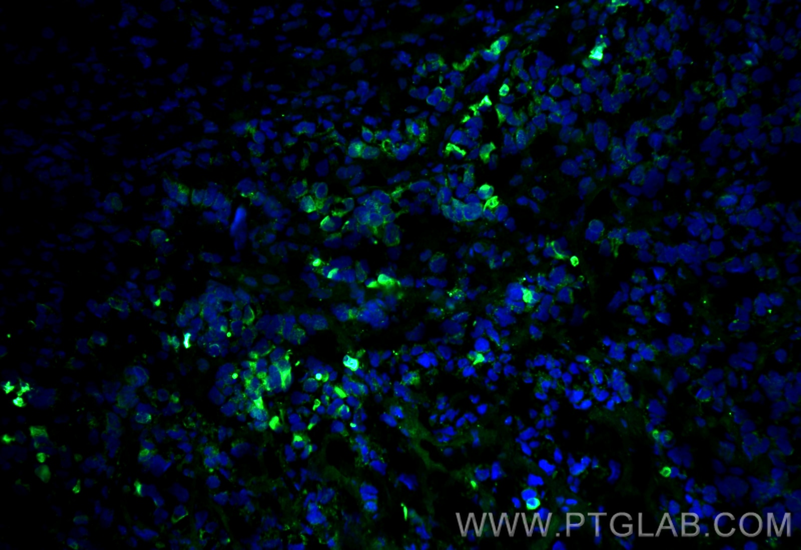 Immunofluorescence (IF) / fluorescent staining of mouse breast cancer using Cytokeratin 7 Polyclonal antibody (15539-1-AP)