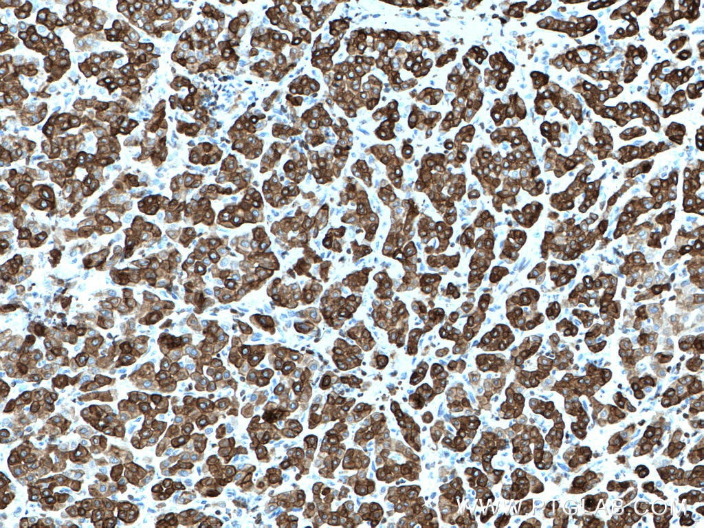 Immunohistochemistry (IHC) staining of human liver cancer tissue using Cytokeratin 7 Polyclonal antibody (15539-1-AP)