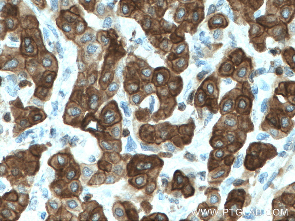 Immunohistochemistry (IHC) staining of human liver cancer tissue using Cytokeratin 7 Polyclonal antibody (15539-1-AP)