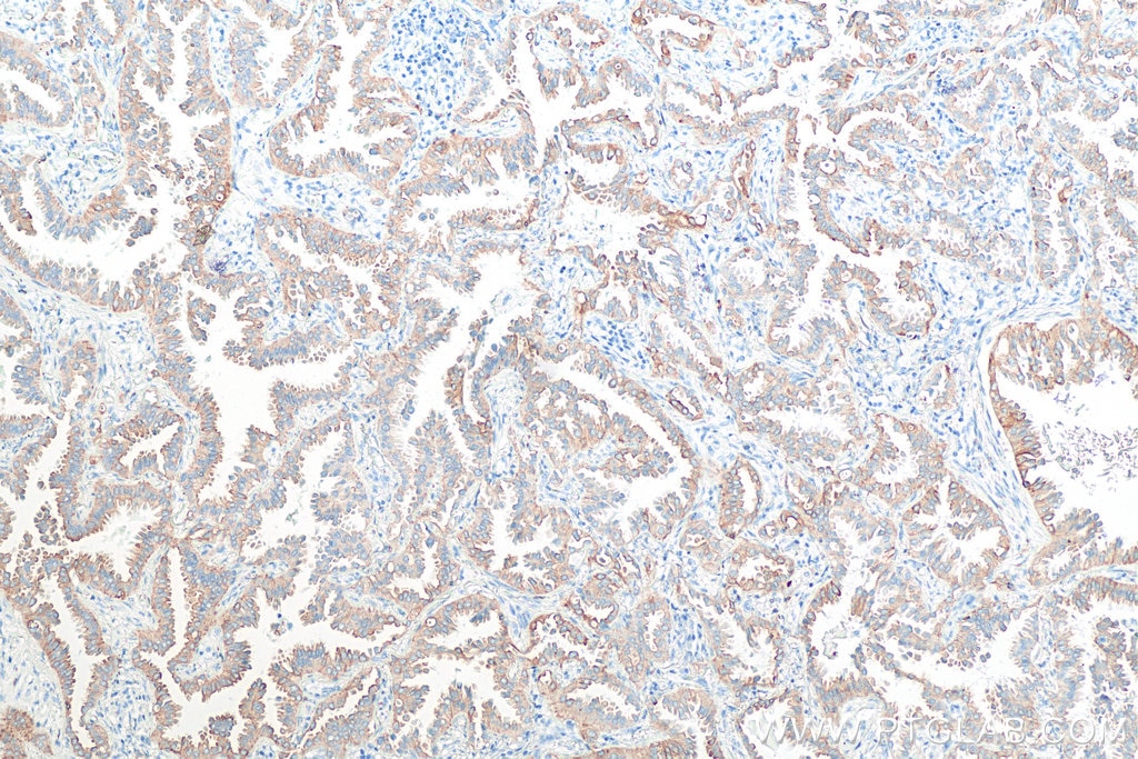 Immunohistochemistry (IHC) staining of human lung cancer tissue using Cytokeratin 7 Polyclonal antibody (15539-1-AP)